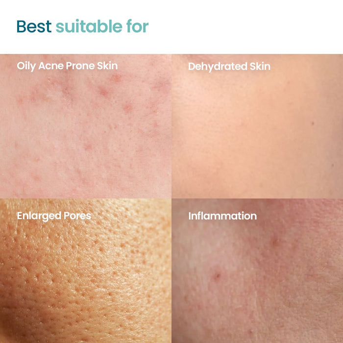Acne Essential Trio