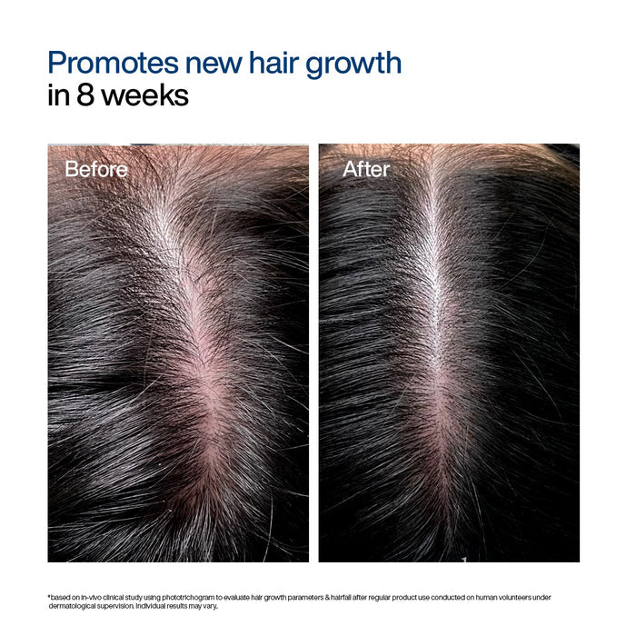 Before and after results of WishCare Hair Growth Serum Roll-On show visible new hair growth along the scalp after regular use.