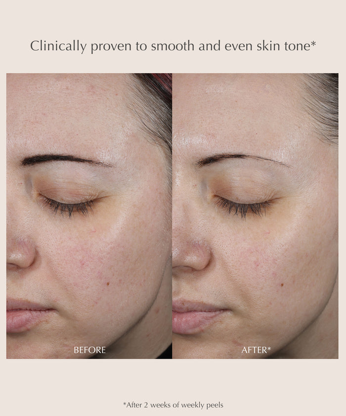 Performance Peel AP25 At-Home Chemical Peel
